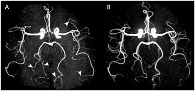 Case report: Meningitis: a cause of reversible cerebral vasoconstriction syndrome?